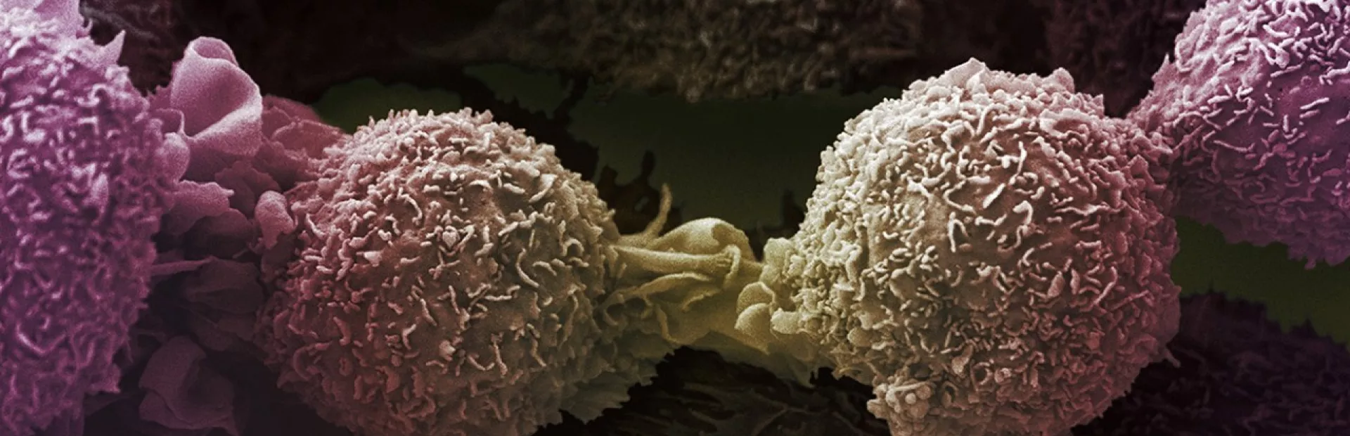 Lung cancer cells by Ann Weston, LRI, CRUK, Welcome Images